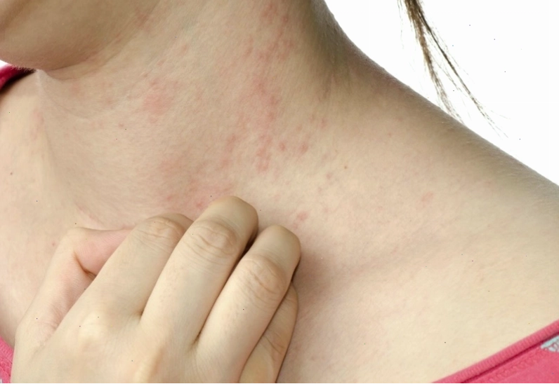 Bị ngứa khắp người có thể do thay đổi thời tiết gây khô da