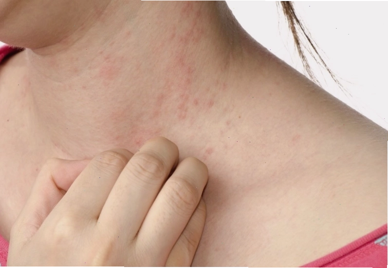 Bị ngứa khắp người có thể do thay đổi thời tiết gây khô da