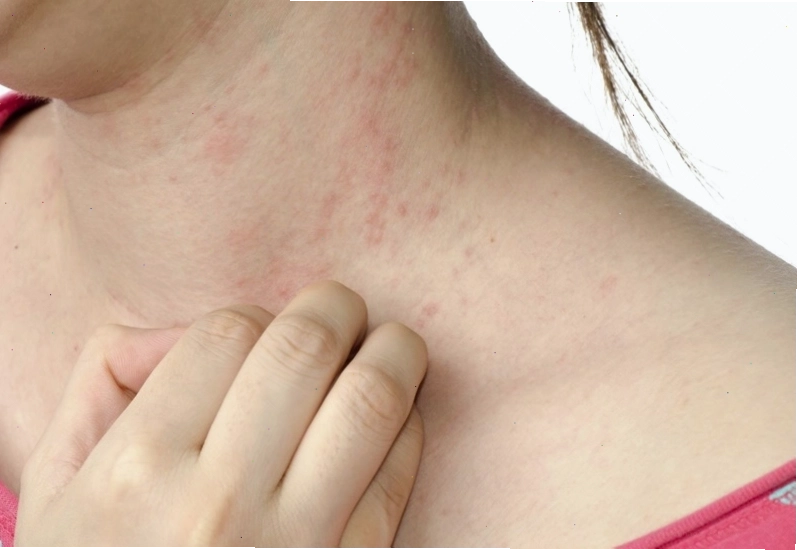 Bị ngứa khắp người có thể do thay đổi thời tiết hoặc tiếp xúc hóa chất