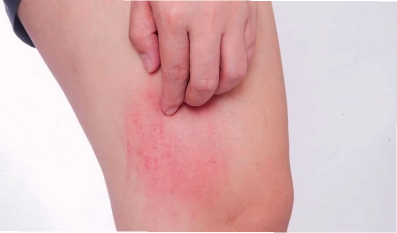 Bị ngứa khắp người do phản ứng dị ứng