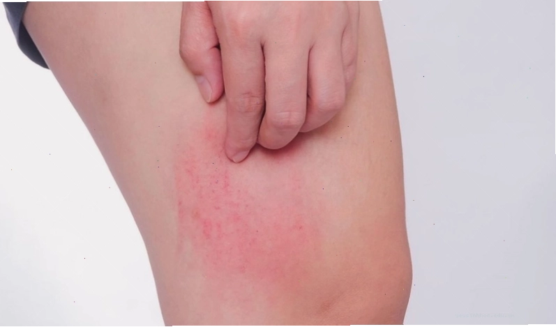 Bị ngứa khắp người không rõ nguyên nhân có thể là triệu chứng đầu tiên của các loại dị ứng