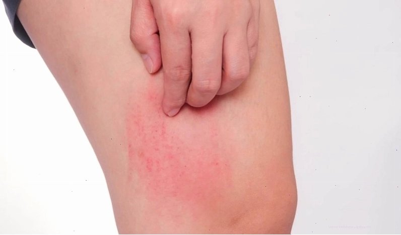 Bị ngứa khắp người không rõ nguyên nhân có thể là triệu chứng của bệnh gan hoặc bệnh tiểu đường