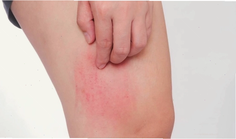 Bị ngứa khắp người không rõ nguyên nhân có thể là triệu chứng đầu tiên của các loại dị ứng.