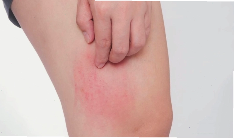 Bị ngứa khắp người không rõ nguyên nhân có thể là triệu chứng đầu tiên của các loại dị ứng