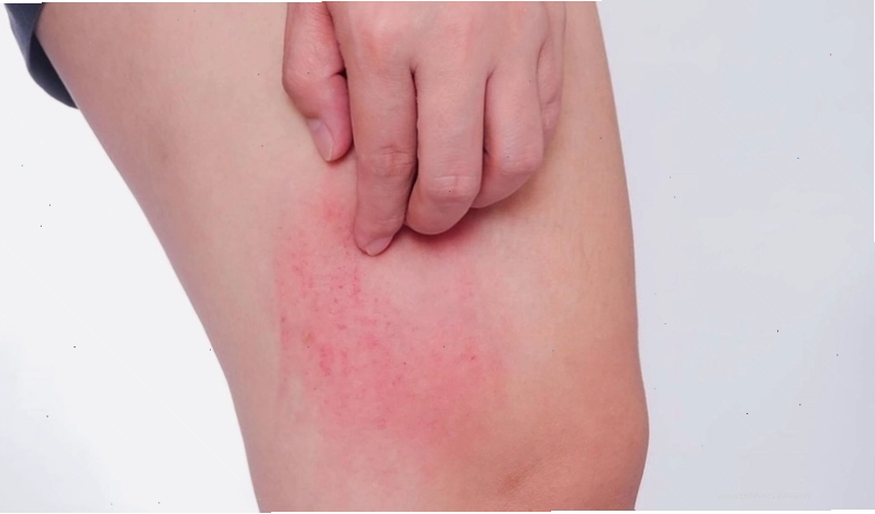 Bị ngứa khắp người không rõ nguyên nhân có thể là triệu chứng đầu tiên của các loại dị ứng
