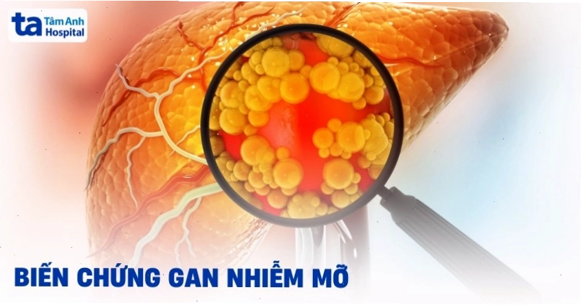 Biến chứng nguy hiểm của gan nhiễm mỡ