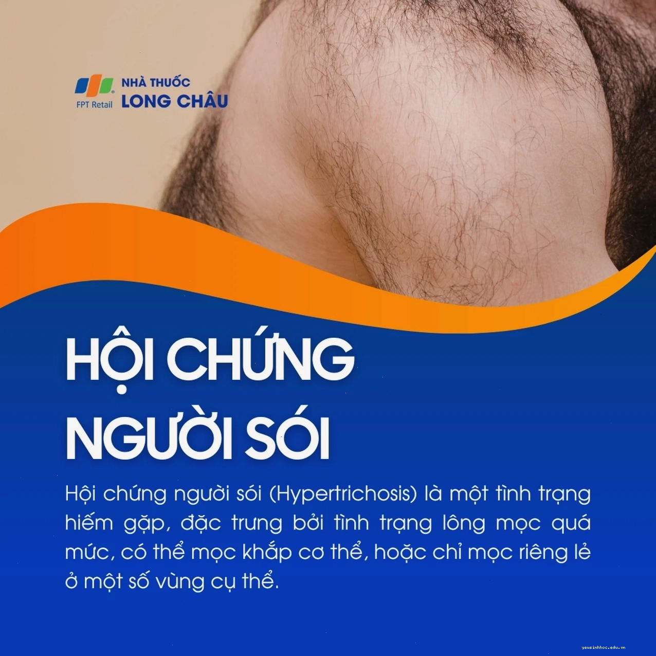 Biểu đồ minh họa sự phát triển nang lông bất thường trong hội chứng người sói