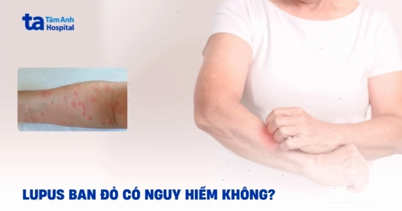 Biểu hiện ban đỏ hình cánh bướm trên mặt là dấu hiệu của Lupus