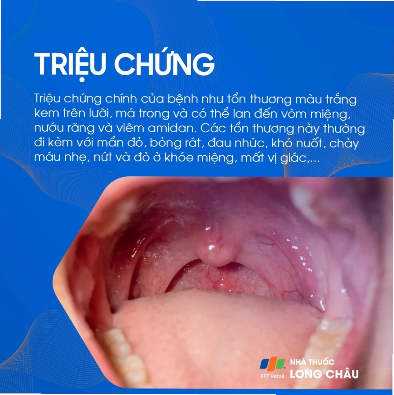 Biểu hiện nấm miệng