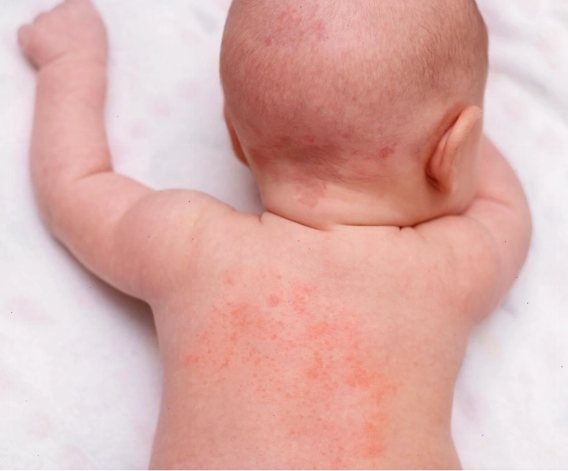 Biểu hiện sốt phát ban ngứa ở trẻ em