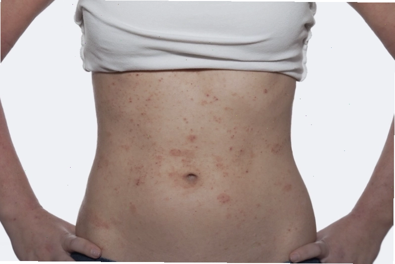 Bít tắc lỗ chân lông là nguyên nhân chính dẫn đến rôm sảy ở người lớn