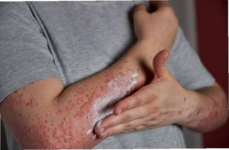 Bôi kem điều trị phát ban trên vùng da bị ảnh hưởng