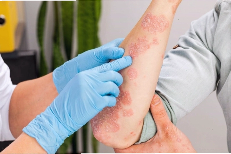 Các loại thuốc điều trị phát ban đỏ ngứa