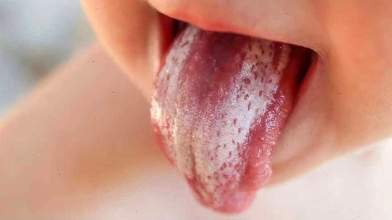Các mảng trắng kem trên bề mặt lưỡi là dấu hiệu điển hình của bệnh nấm lưỡi ở người lớn