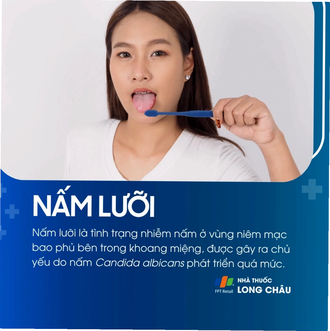 Các mảng trắng là biểu hiện phổ biến của nấm lưỡi