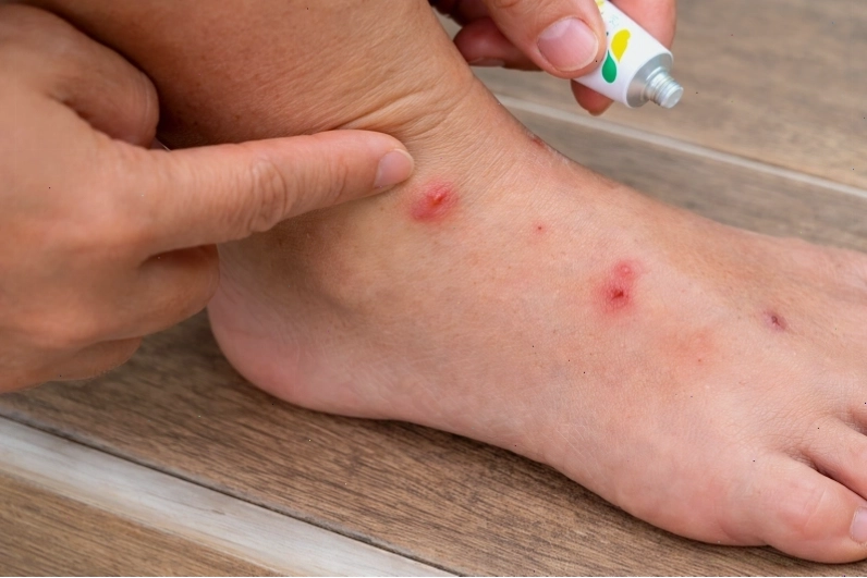 Các nốt bọ chó đốt xuất hiện thành cụm ở vùng cổ chân và cẳng chân