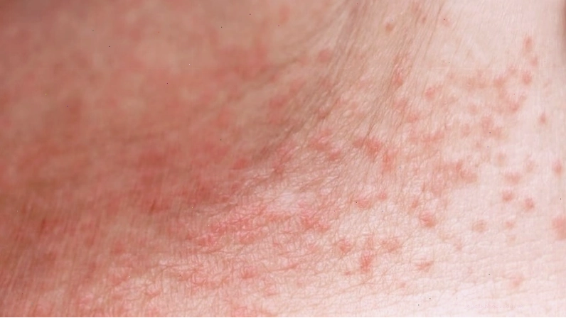 Các nốt rôm sảy đỏ li ti trên da