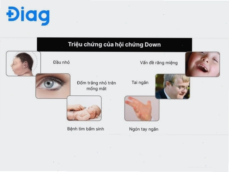 Các triệu chứng đặc trưng của hội chứng Down Trisomy 21 bao gồm khuôn mặt tròn, mắt xếch và trương lực cơ giảm.