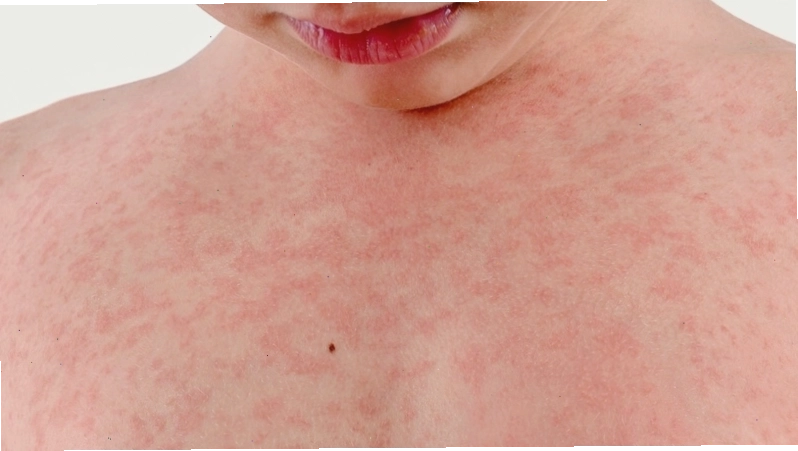 Cách trị nổi mẩn đỏ ngứa tại nhà
