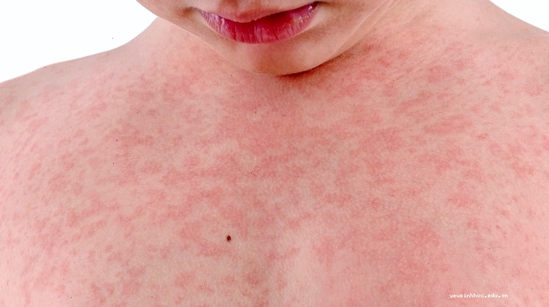 Cách trị nổi mẩn đỏ ngứa tại nhà hiệu quả