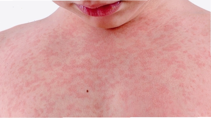 Cách xử lý tình trạng nổi mẩn đỏ ngứa như muỗi đốt