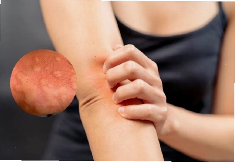 Cảm giác ngứa ngáy khó chịu vào ban đêm khiến người bệnh rất mệt mỏi