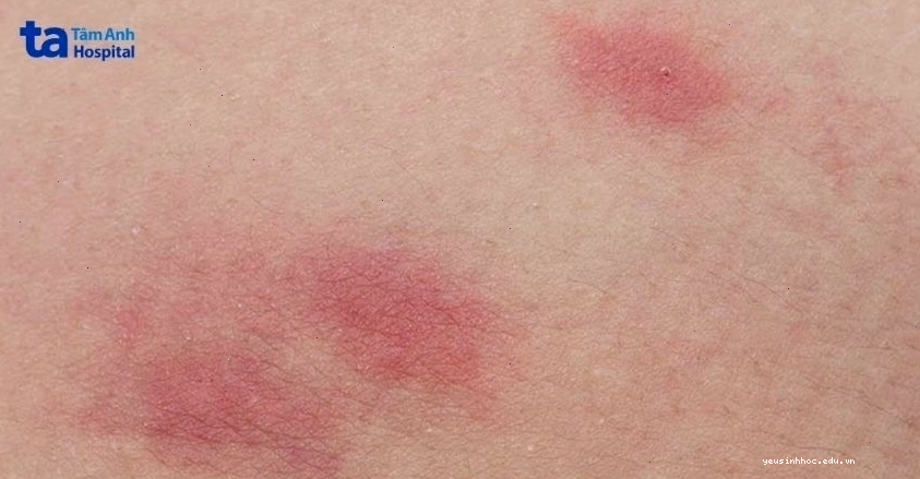 Chấm đỏ trên da có thể là dấu hiệu của nhiều bệnh lý nguy hiểm
