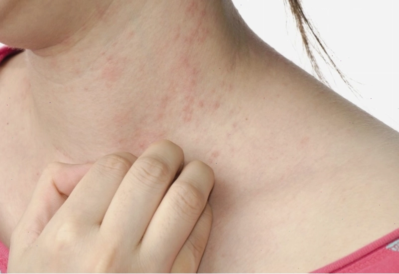 Da bị ngứa do thay đổi thời tiết hanh khô