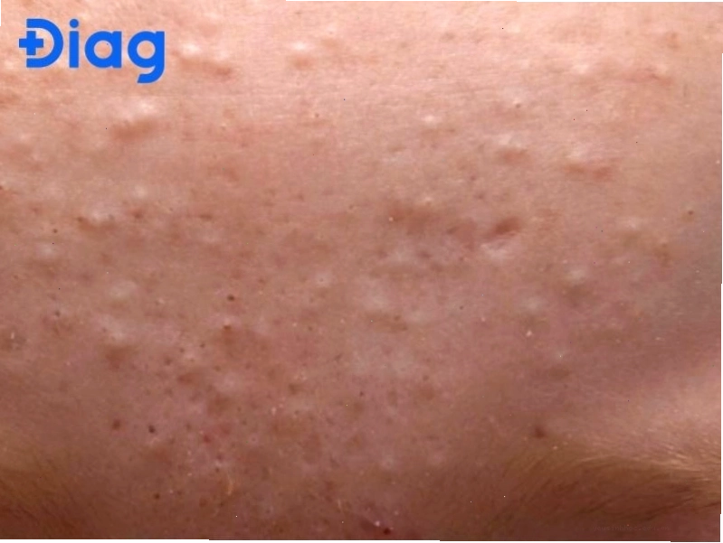 Da bị nổi hột trắng không ngứa có thể là mụn ẩn