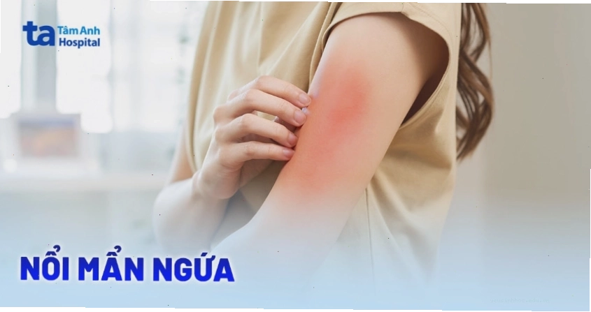 Da bị nổi mẩn đỏ ngứa lan rộng khắp cơ thể