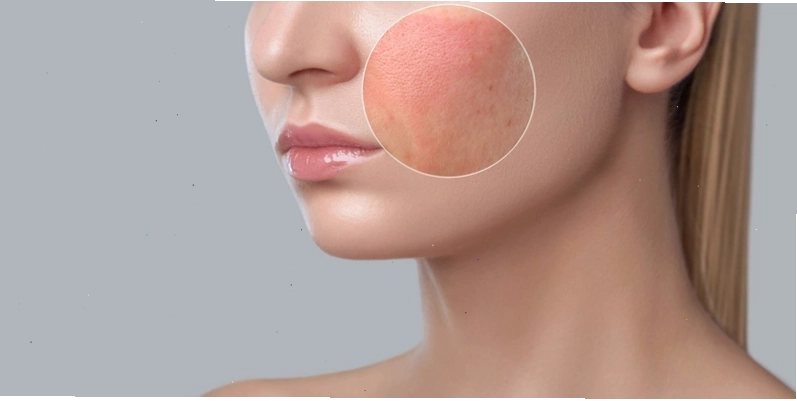 Da bị nổi mẩn đỏ ngứa với các nốt li ti lan rộng