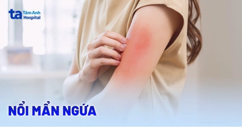 Da người bị nổi mẩn ngứa đỏ toàn thân, biểu hiện của dị ứng hoặc phản ứng cơ thể