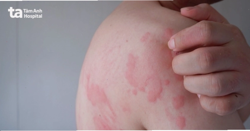 Da nổi đốm nâu và ngứa có thể do tăng sắc tố sau viêm