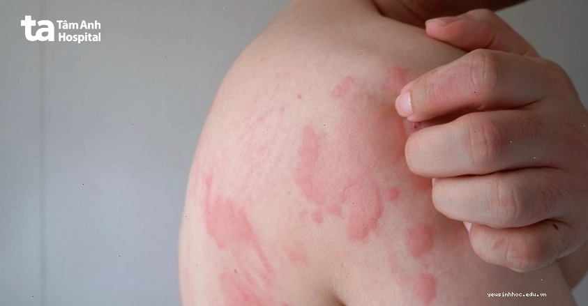 Da nổi đốm nâu và ngứa có thể là dấu hiệu của nhiều bệnh lý