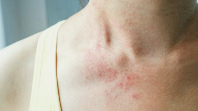 Đặc điểm lâm sàng của phát ban do nhiễm HIV giúp phân biệt với các loại phát ban khác