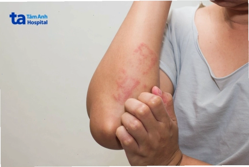 Dấu hiệu viêm da cơ địa ở người lớn