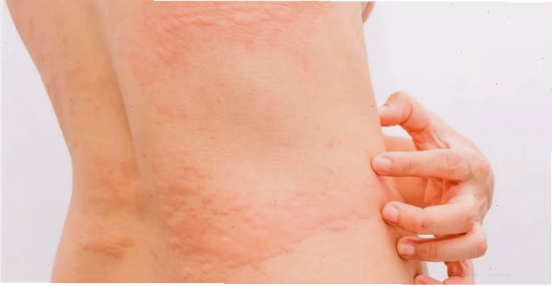 Dị ứng làm xuất hiện các mẩn đỏ gây cảm giác ngứa ngáy khó chịu sau khi quan hệ