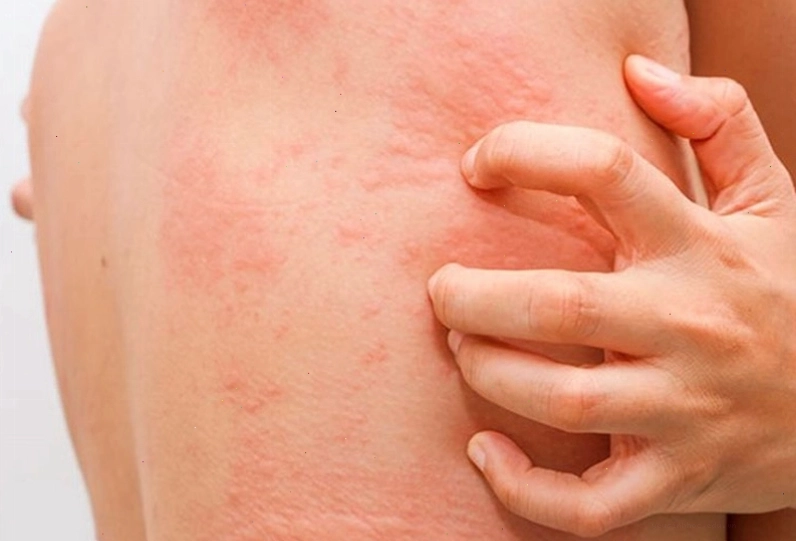 Dị ứng sau quan hệ có thể bị ở cả nam lẫn nữ hoặc 1 trong 2 người