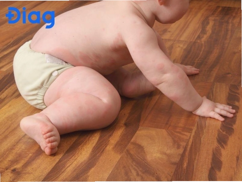 Dị ứng thời tiết là nguyên nhân gây nổi mề đay ở trẻ