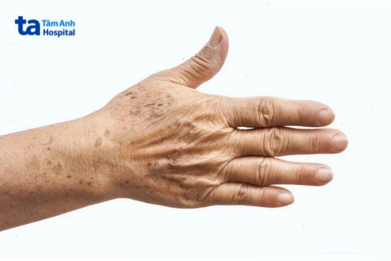 Đồi mồi ở người già thường xuất hiện ở vùng da bàn tay