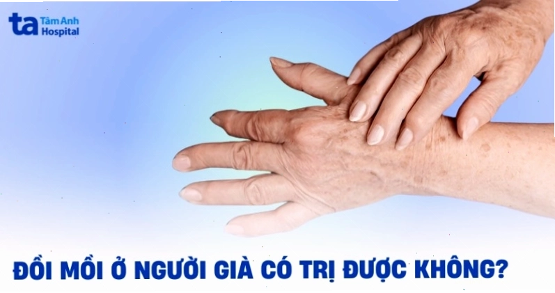 Đồi mồi ở người già xuất hiện do lão hóa và tiếp xúc tia UV lâu dài