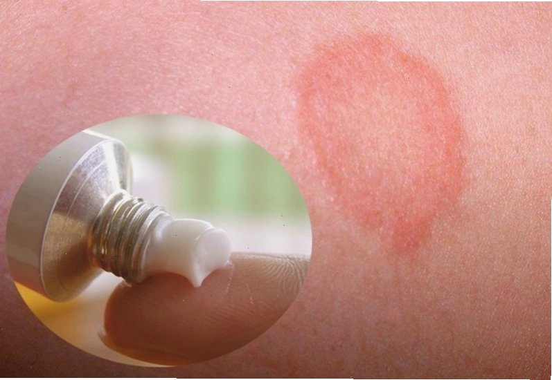 Dùng thuốc dạng bôi để giảm triệu chứng bệnh nấm đồng xu