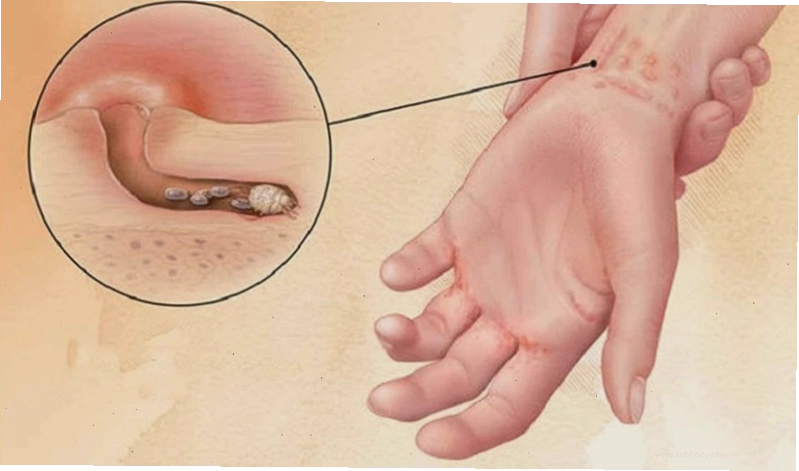 Đường hầm do cái ghẻ đào gồ lên trên da người bị ghẻ