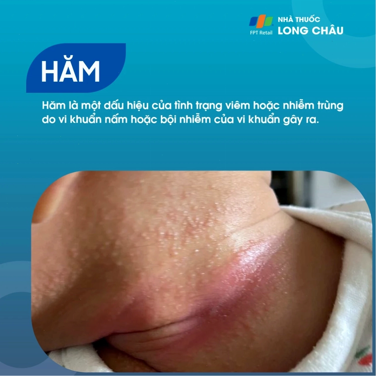 Giữ da khô thoáng là biện pháp quan trọng khi bị hăm