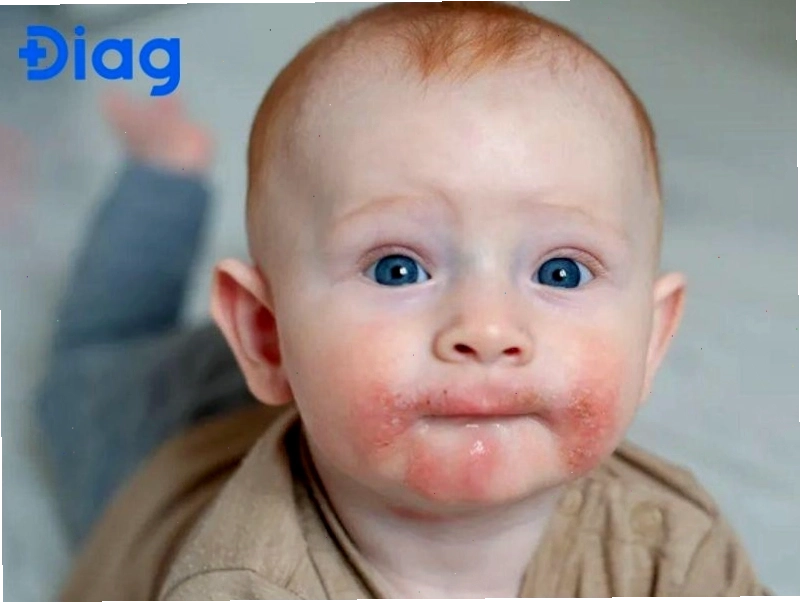 Hai ký sinh trùng Demodex trên da mặt là nguyên nhân gây viêm nhiễm nang lông