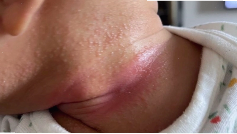 Hăm da gây kích ứng, nổi mẩn đỏ tại vùng da có nếp gấp