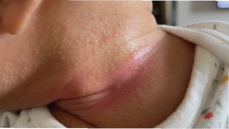Hăm da là tình trạng da bị kích ứng, nổi mẩn đỏ tại vùng da có nếp gấp