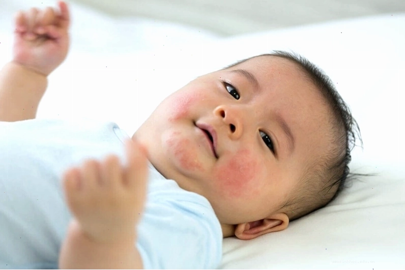 Hiện tượng mẩn đỏ ở trẻ sơ sinh có thể do nhiều nguyên nhân, bao gồm cả bệnh lý
