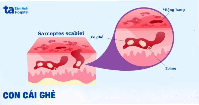 Hình ảnh con cái ghẻ (Sarcoptes scabiei) dưới kính hiển vi