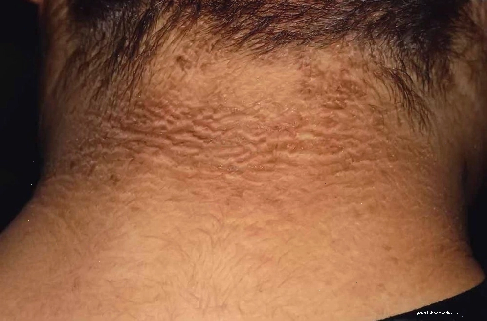 Hình ảnh da người bị tiểu đường mắc chứng gai đen ở vùng cổ